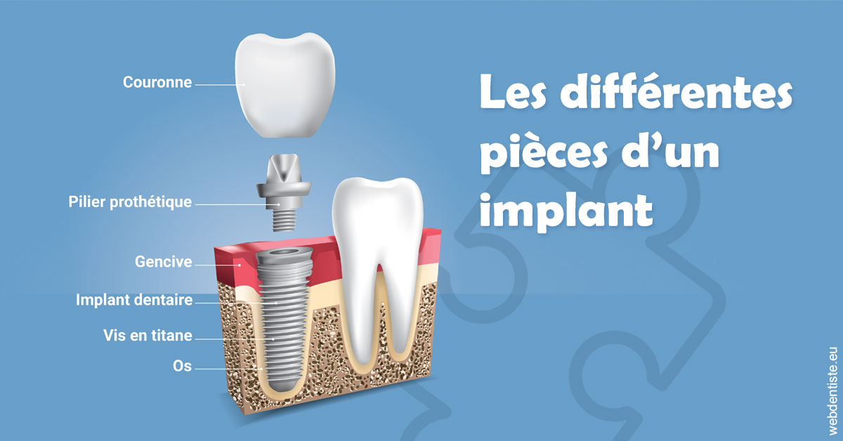 https://dr-cohen-guedj-sophie.chirurgiens-dentistes.fr/Les différentes pièces d’un implant 1